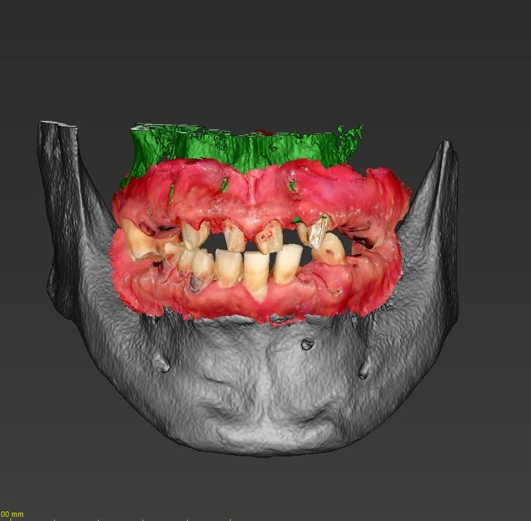 3D dental imaging used for full-arch implant treatment planning