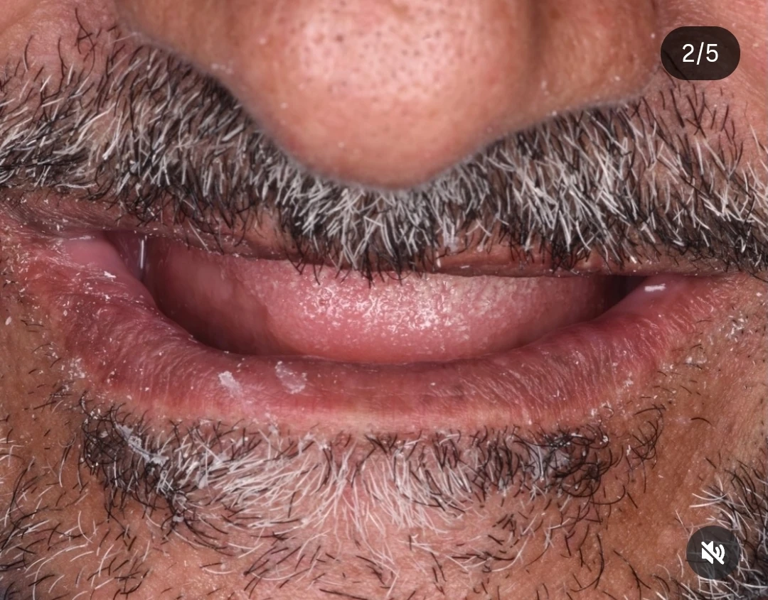 تعويضات ثابتة على الزرعات لكامل الفك — before