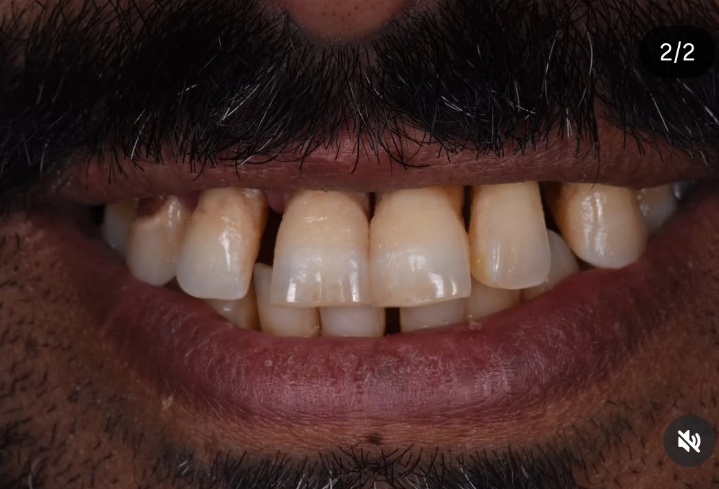 زراعة رقمية لكامل الفك — before