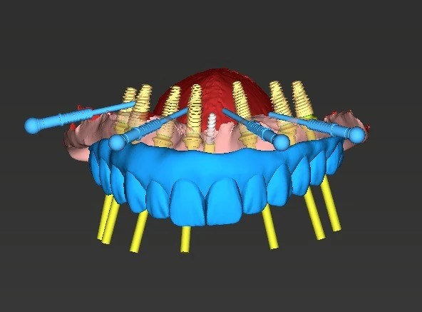 Digital prosthetically driven planning for full-arch dental implants