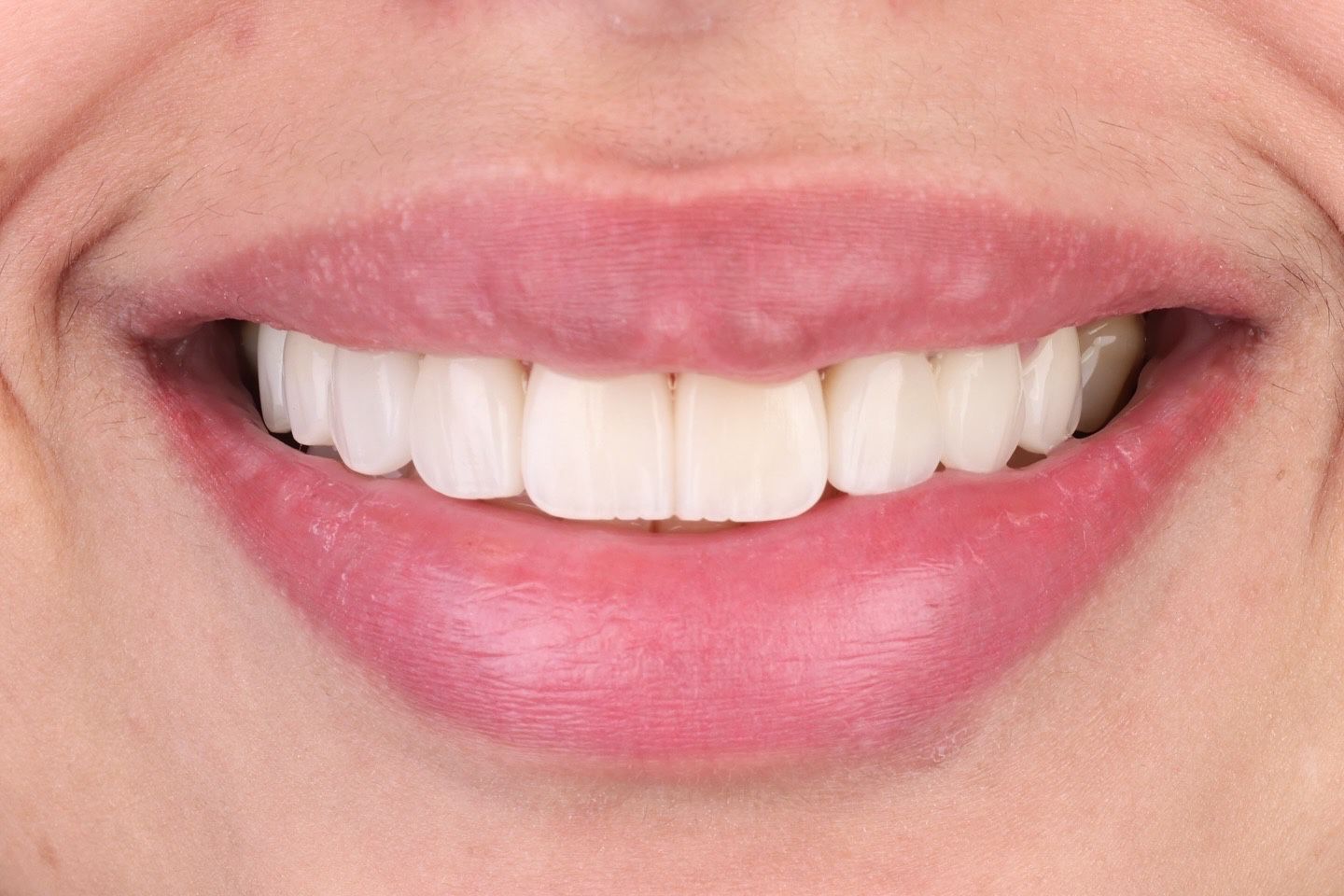 Smile after porcelain veneer treatment