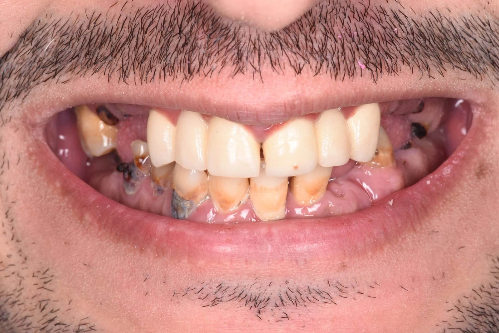 Before full-arch dental implant treatment showing compromised dentition