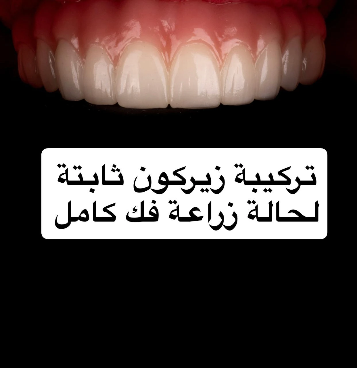 تركيبة زيركون ثابتة لفك كامل لحالة زراعة الأسنان الكاملة