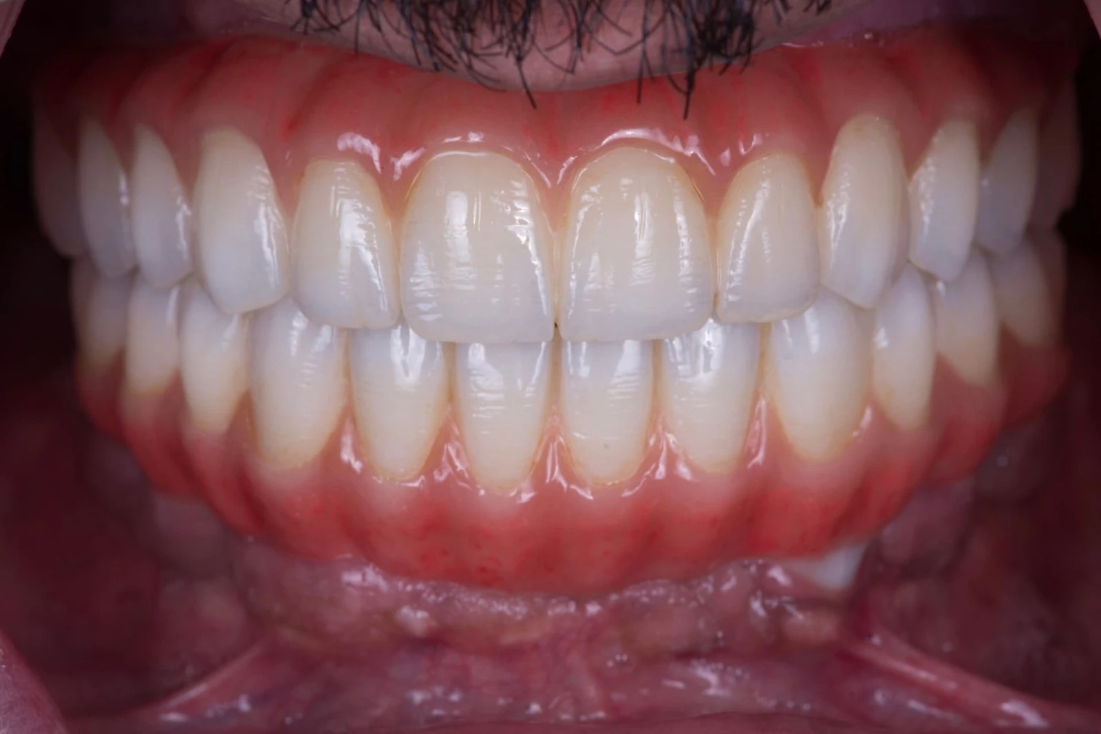 Final zirconia full-arch implant prostheses upper and lower arches