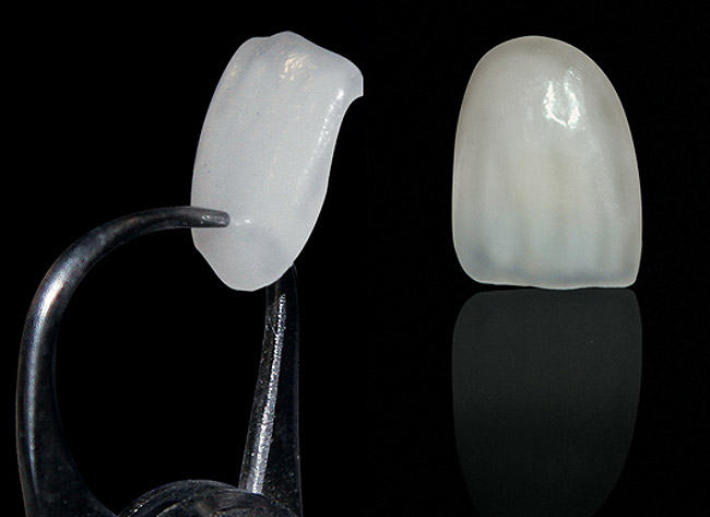 Thin porcelain veneer shell