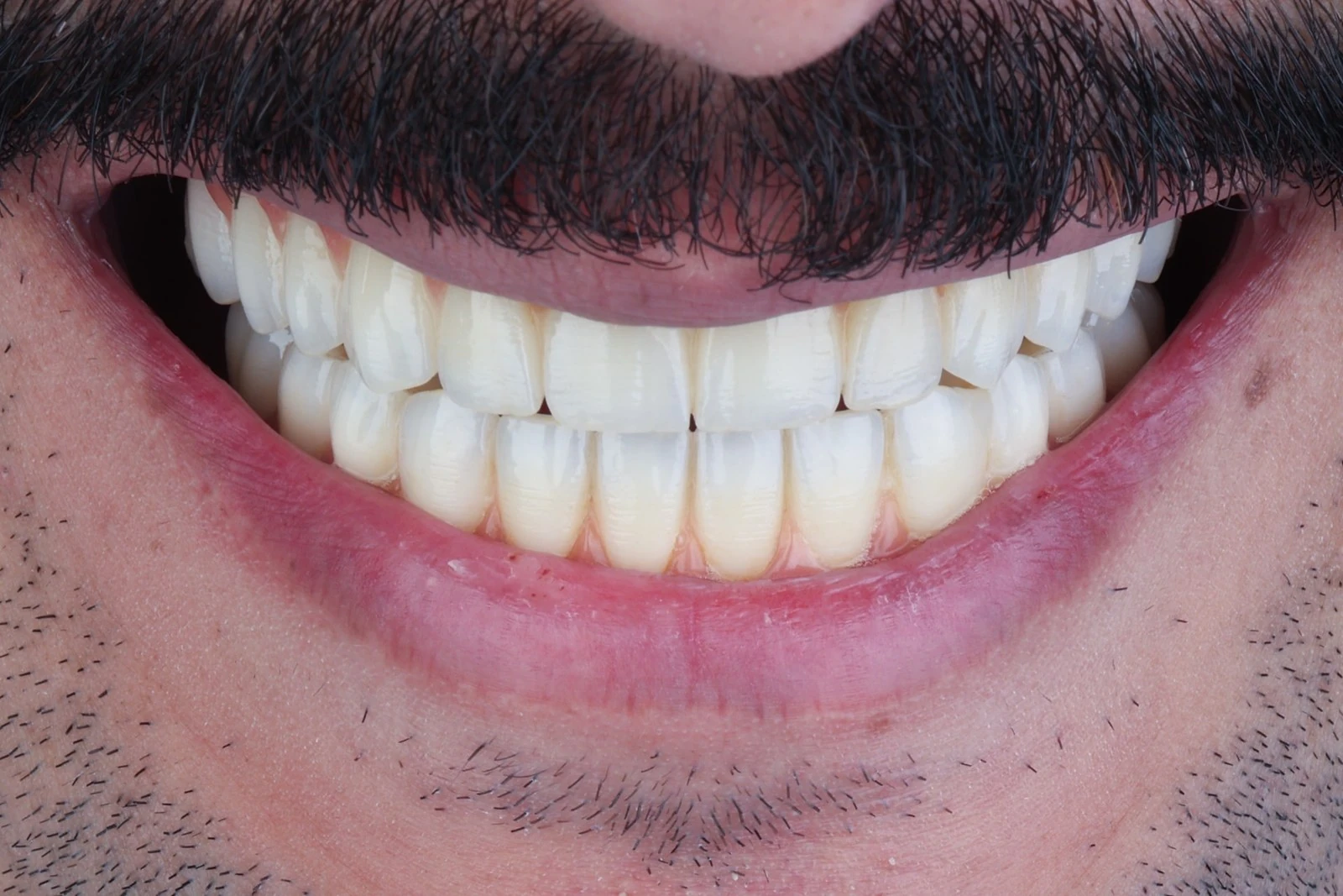 Final smile after upper and lower full-arch dental implant rehabilitation