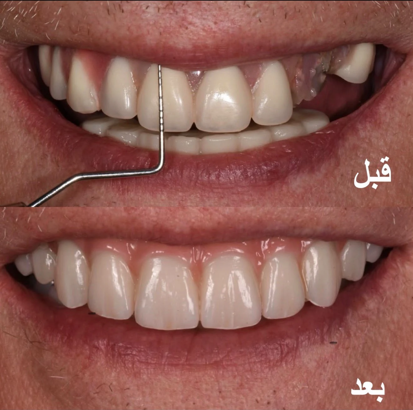 مقارنة قبل وبعد لحالة تركيبة زراعة الفك الكامل