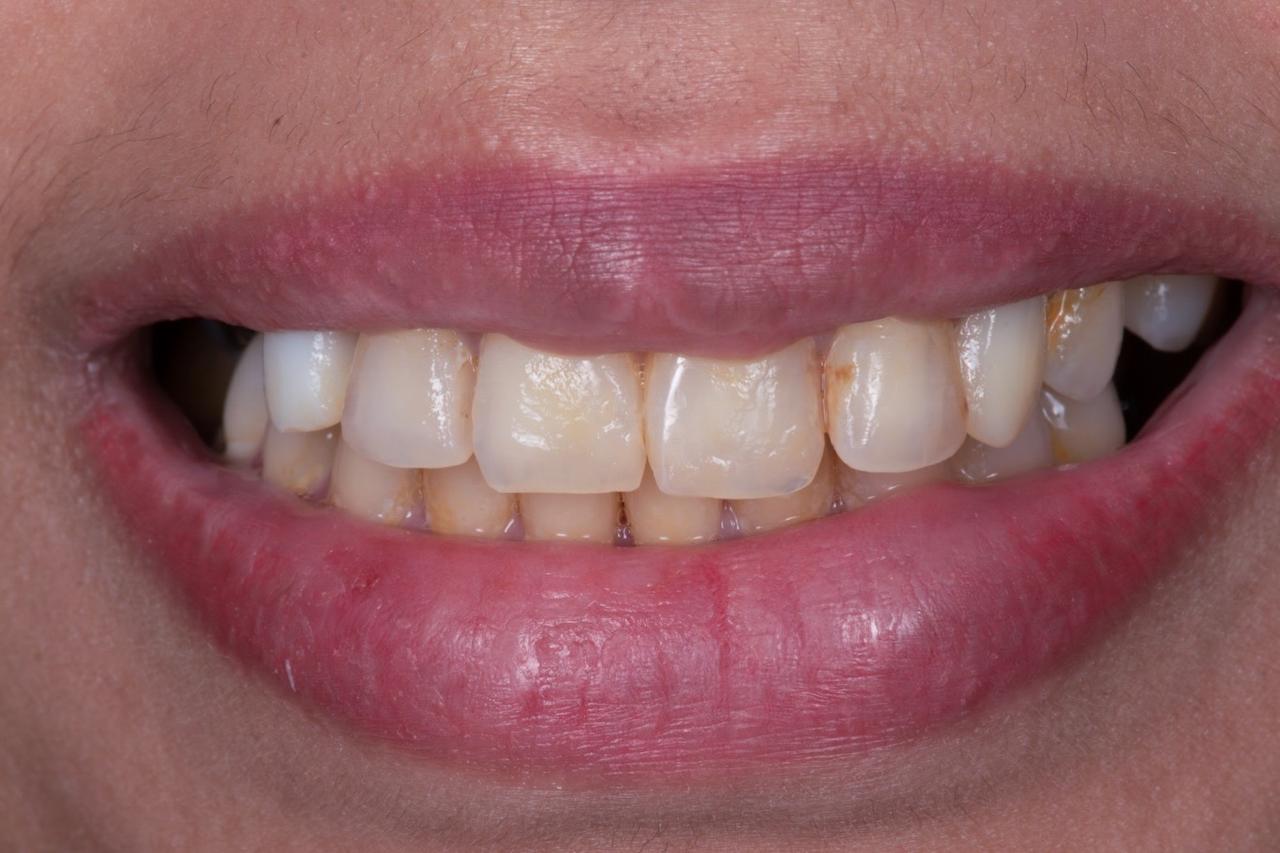 Smile before porcelain veneer treatment
