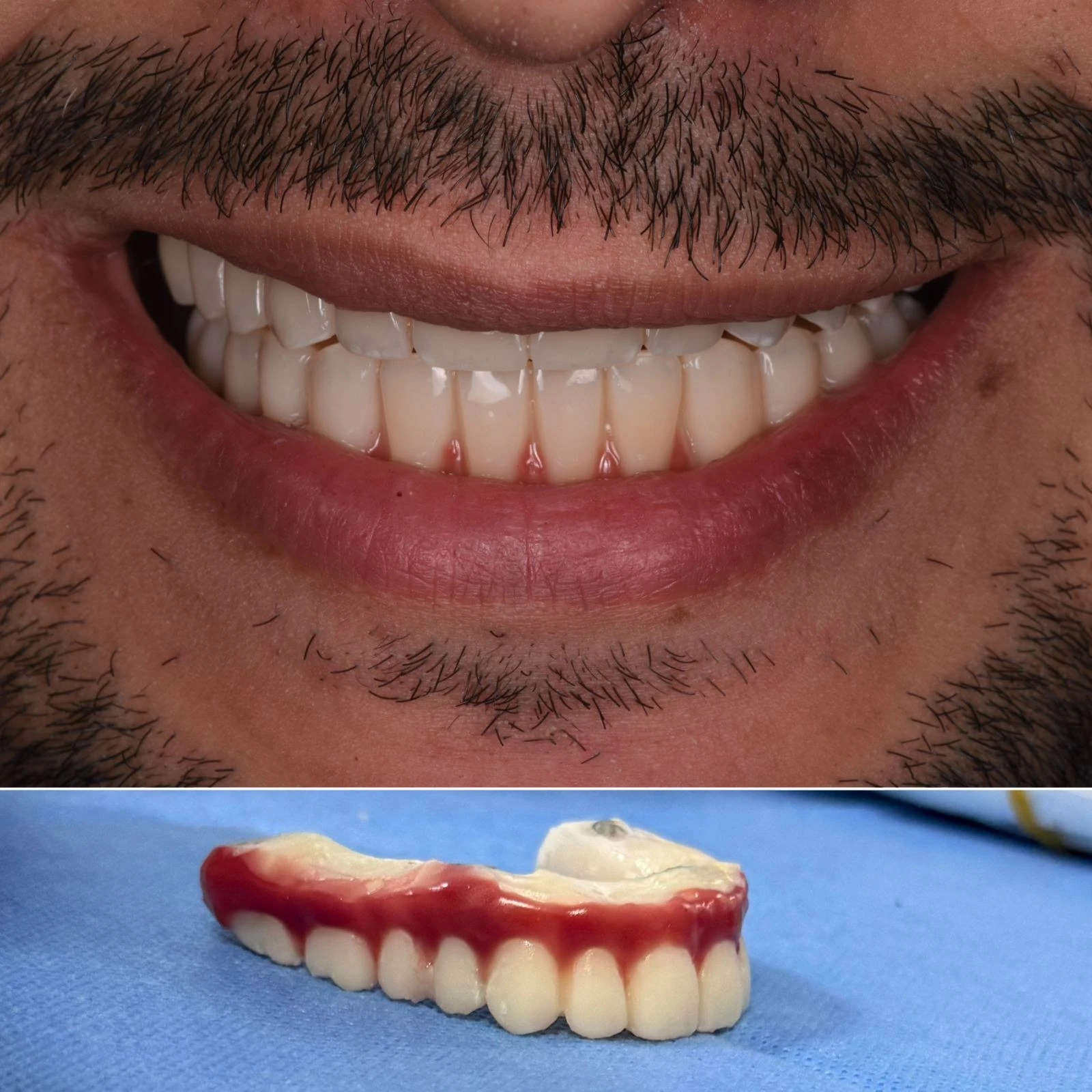 Immediate fixed provisional teeth after full-arch implant placement