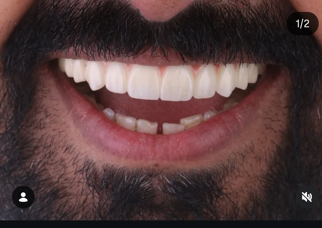 زراعة رقمية لكامل الفك — after