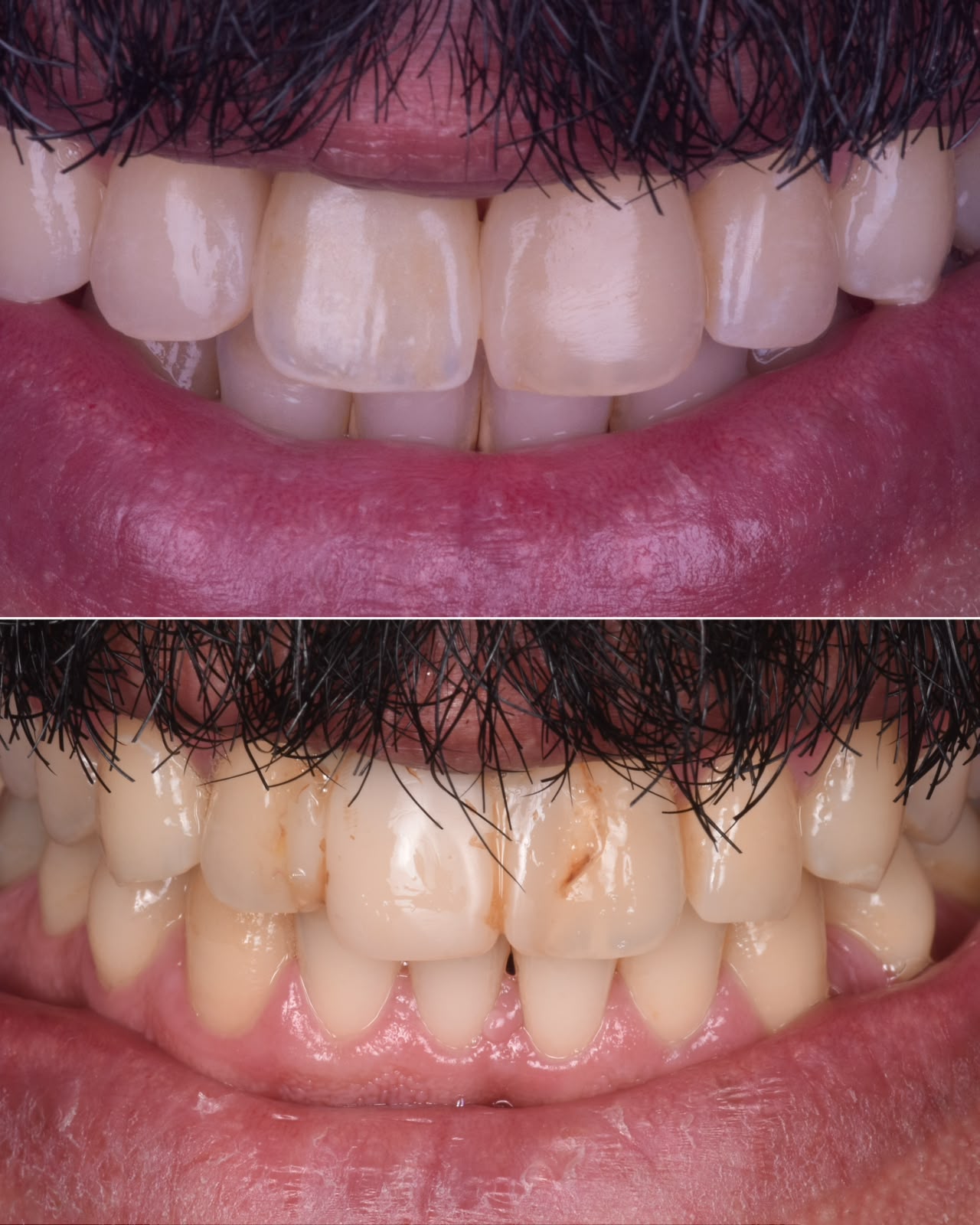مقارنة الابتسامة قبل وبعد زراعة السن الأمامي والتعديلات التجميلية بالكومبوزت